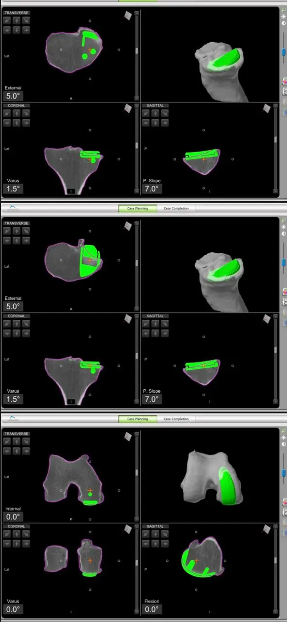Robotic-assisted knee replacement planning reviewed in Abu Dhabi, UAE