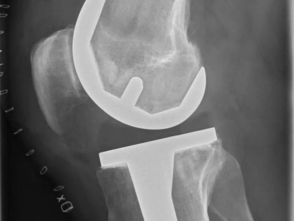 Lateral X-ray showing a total knee replacement prosthesis