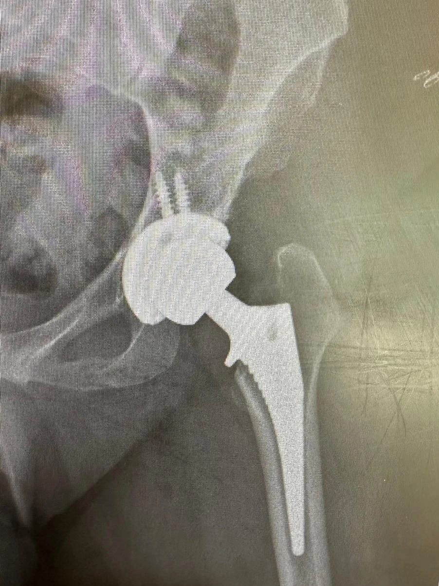 Postoperative X-ray showing a total hip replacement