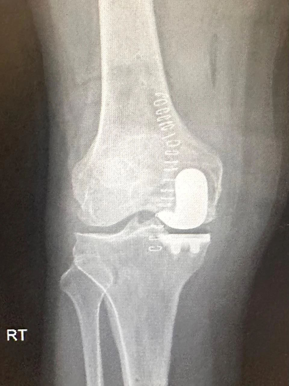 Postoperative X-ray showing a unicompartmental partial knee replacement
