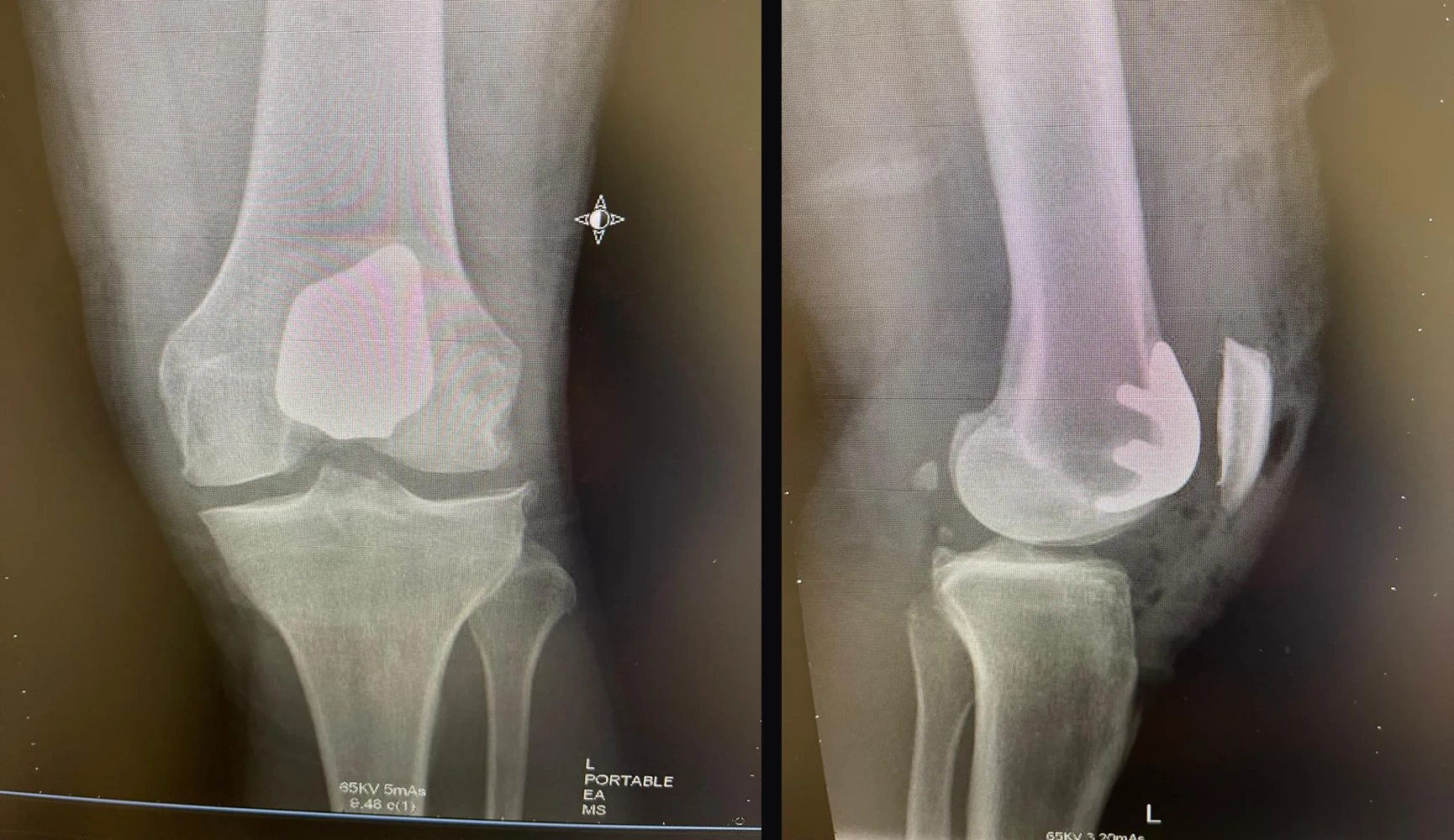 Postoperative frontal and lateral X-rays of patellofemoral replacement