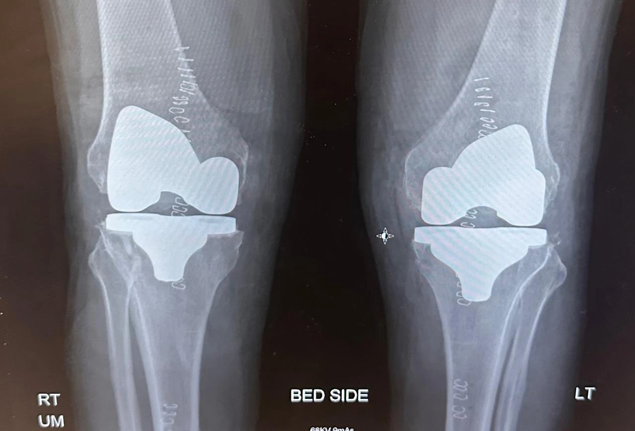 Postoperative X-ray showing total knee replacement components